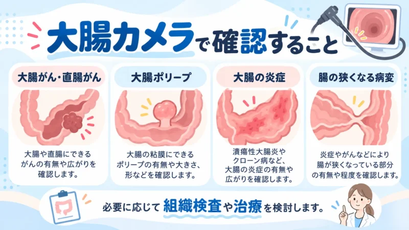 大腸カメラで確認できる大腸がん、直腸がん、大腸ポリープ、炎症や潰瘍、腸の狭窄を紹介した図解