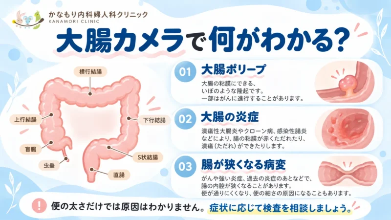 大腸カメラで確認できる大腸ポリープ、大腸の炎症、腸が狭くなる病変を大腸の図とともに説明した画像
